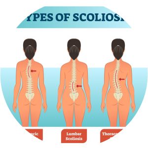 Adult Scoliosis