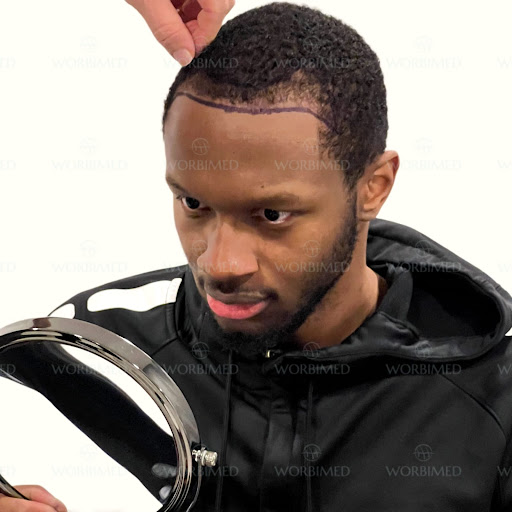 Afro Hair Transplant in Turkey l Best Afro Hair Transplant in Turkey