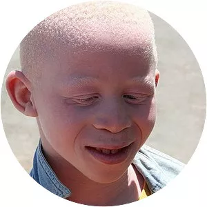 Albinism