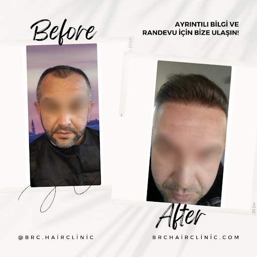 BRC Hair Clinic - Hair replacement service in Istanbul