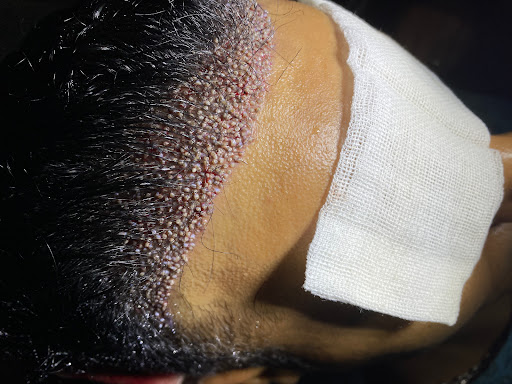 Greffe de cheveux Turquie Dhi - 