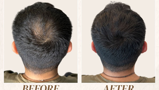 SC SMP CENTER - Hair replacement service in Istanbul